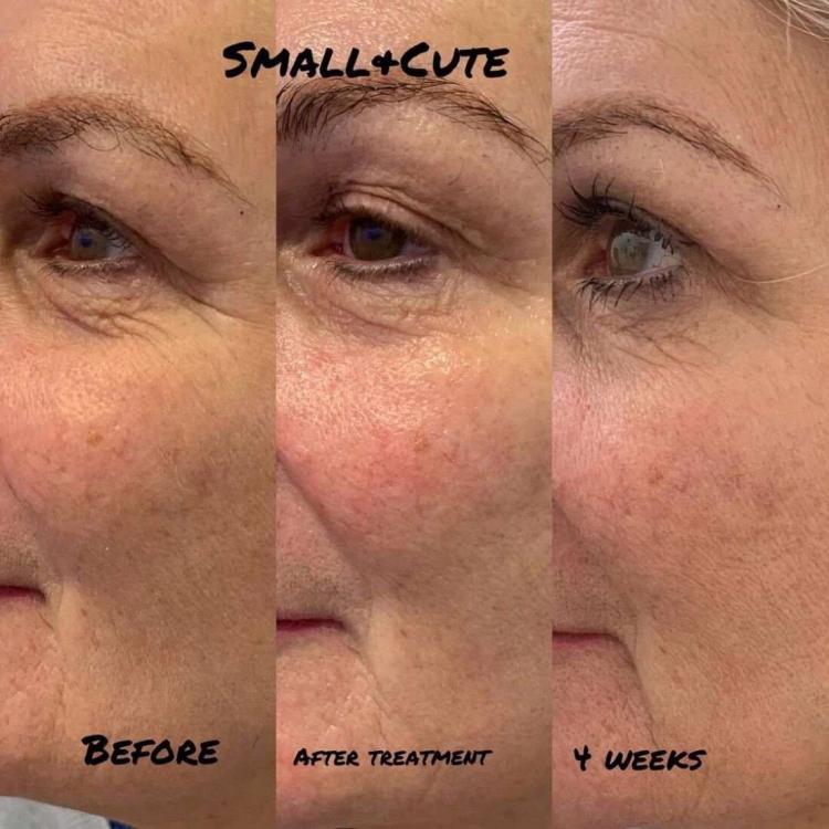 hifu rf ultrasonic facial machine