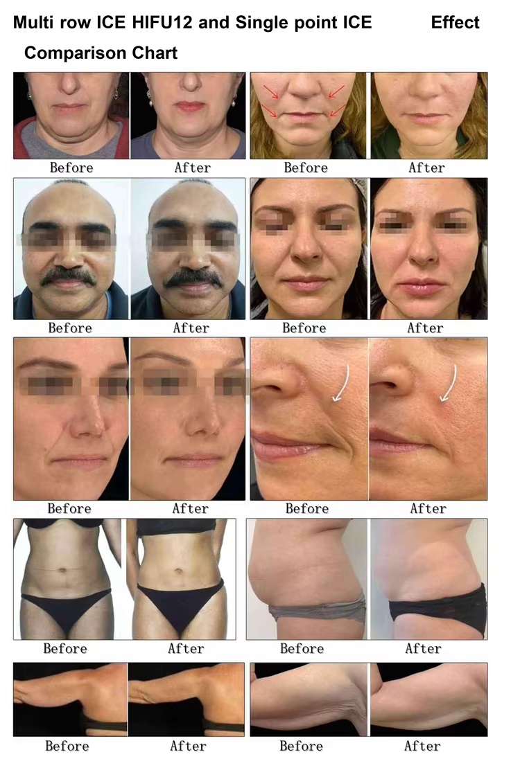 hifu facial machine cost