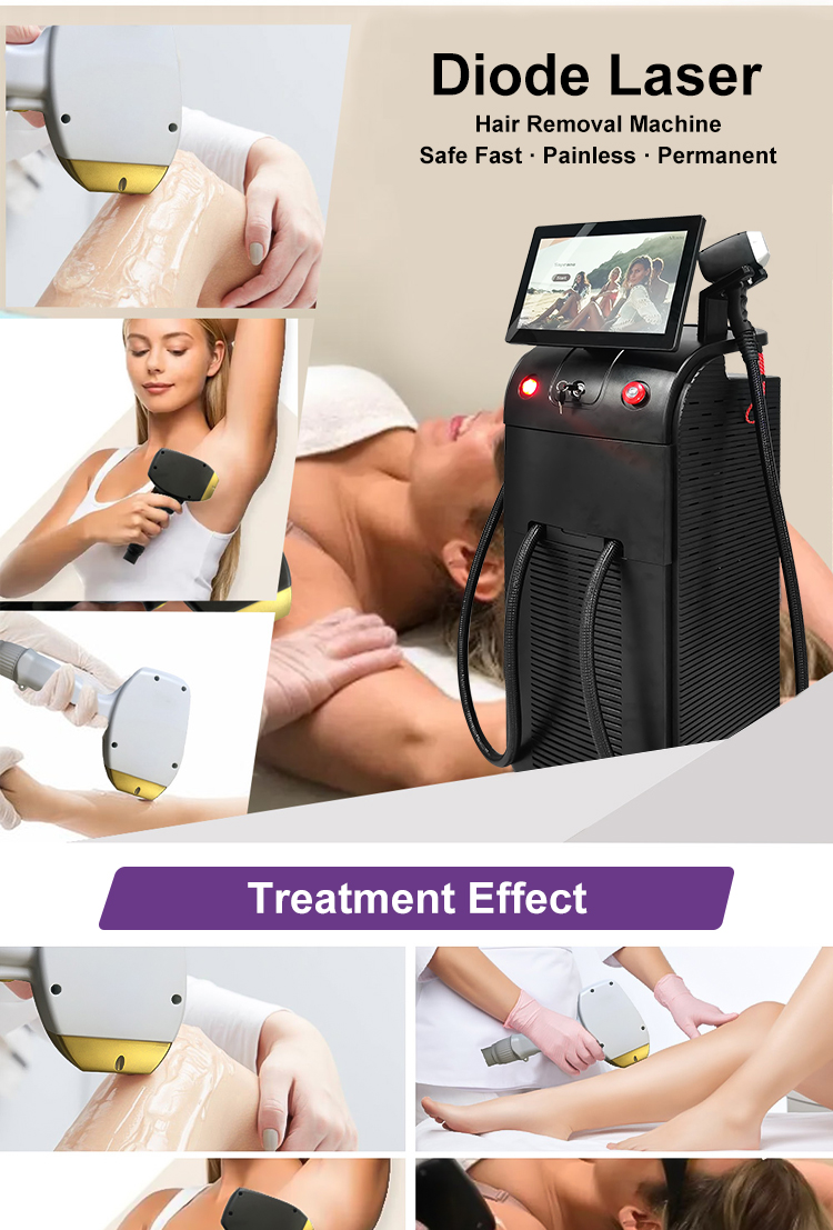 diode laser hair removal machine