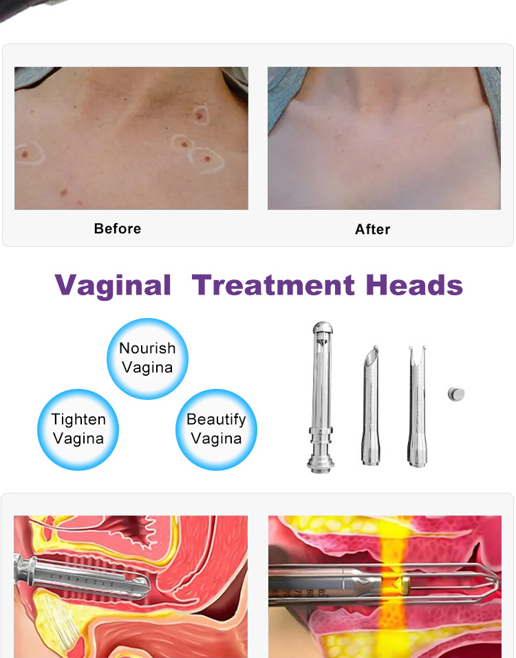 skin rejuvenation CO2 laser system06