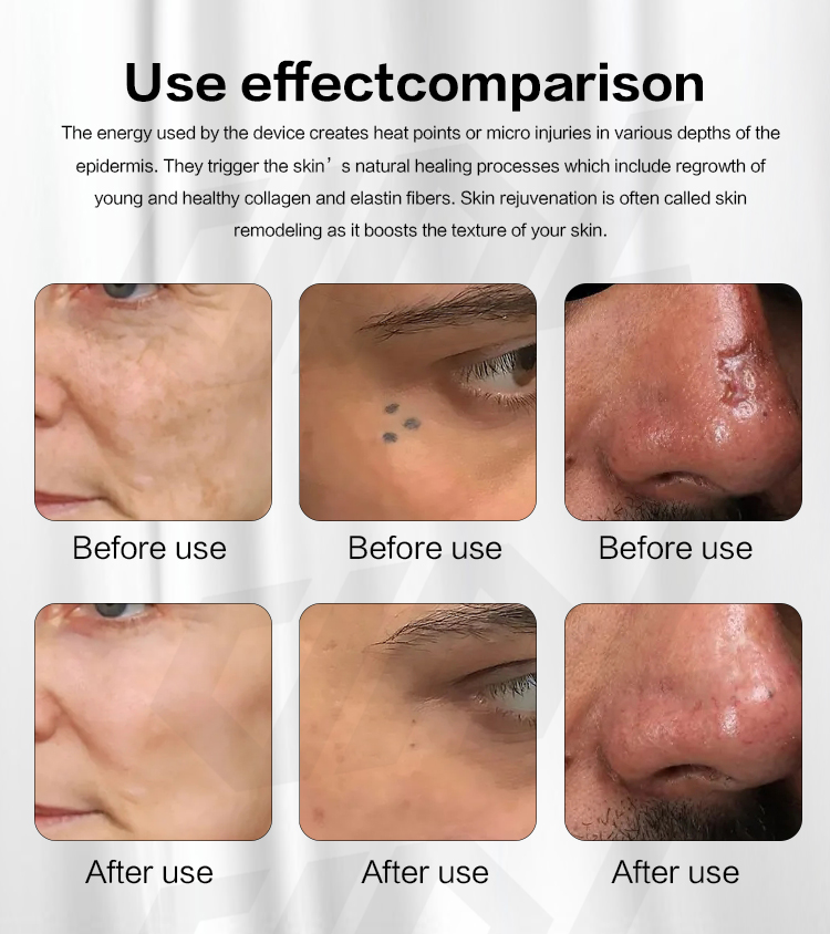 skin rejuvenation CO2 laser system12