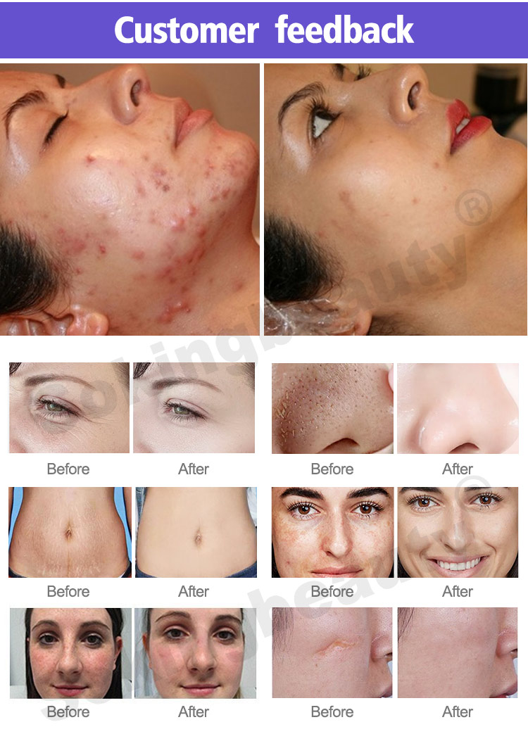 cost of co2 laser machine10