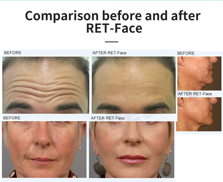 face lift machine before after