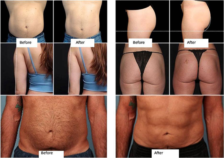 before and after of ems body sculpt machine