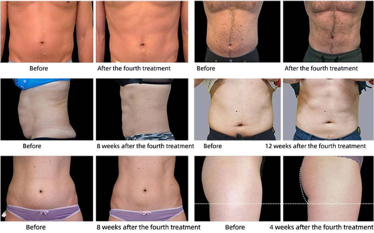 ems muscle sculpt before after