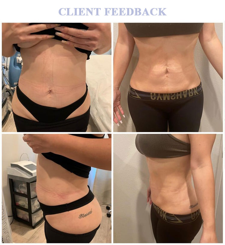 ems body sculpt before after