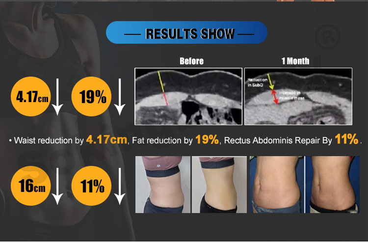 ems sculpt machine