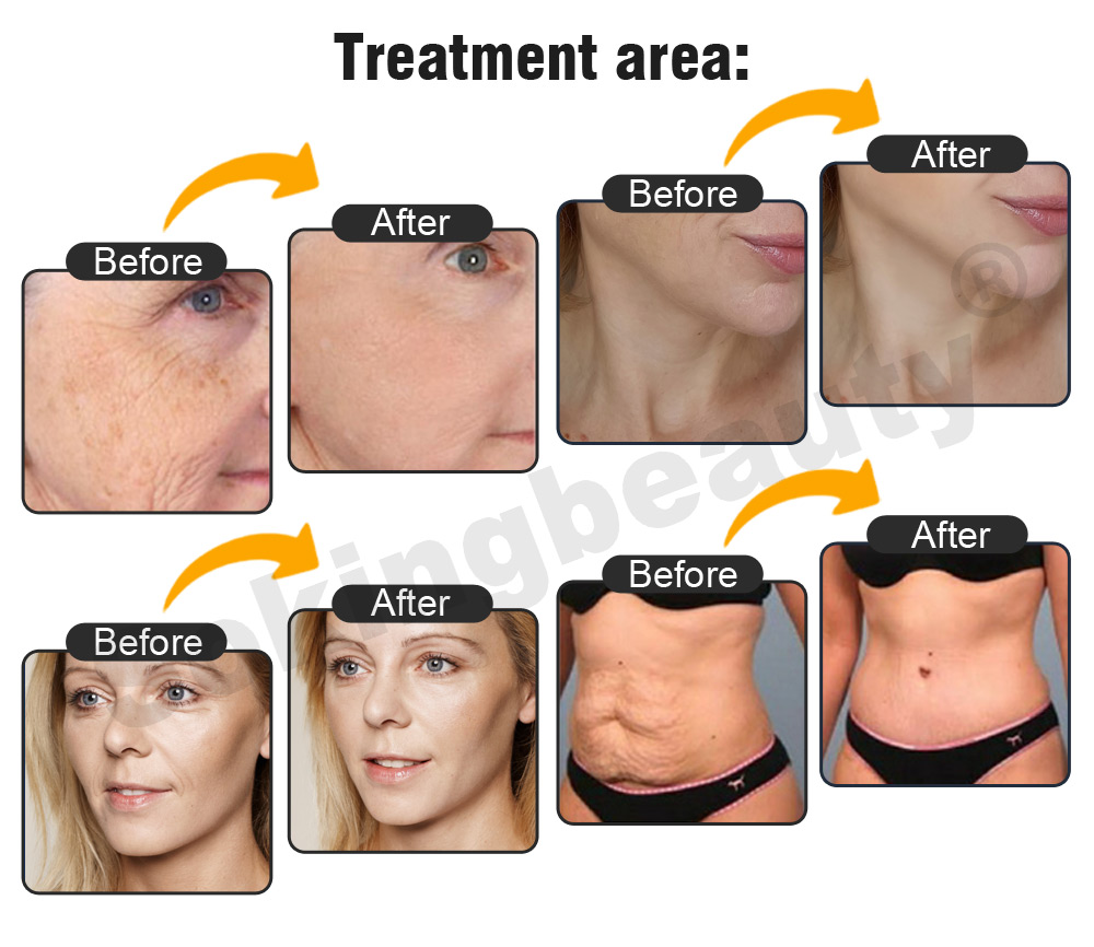 OEM ODM HIFU Skin Firming Aesthetic equipment