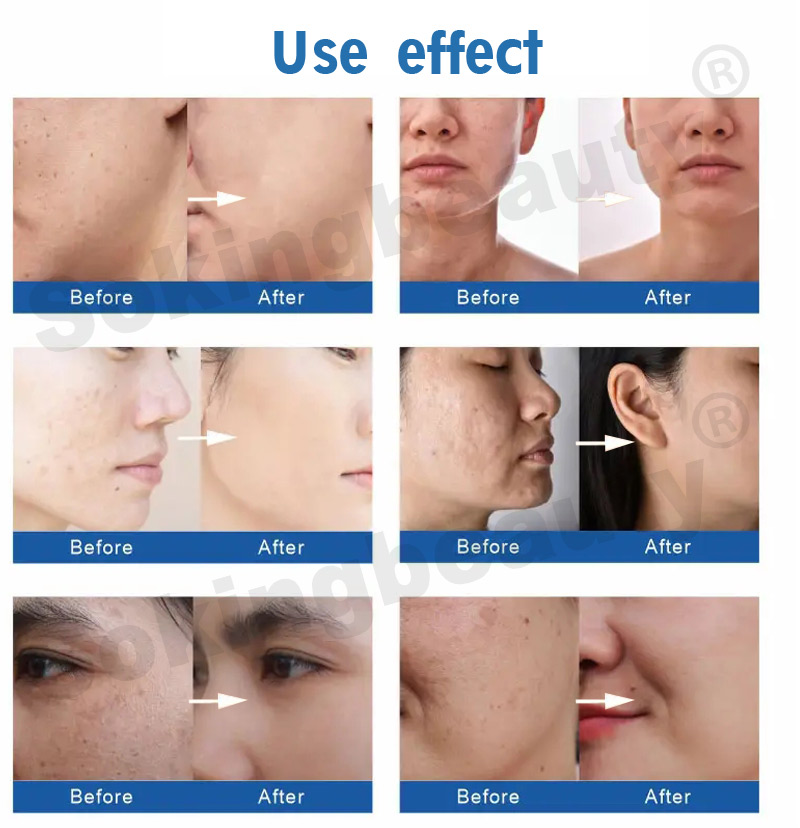 8IN1 Hydro Dermabrasion facial Diamond device