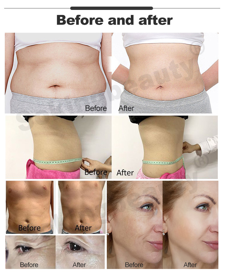 smart tecar therapy14