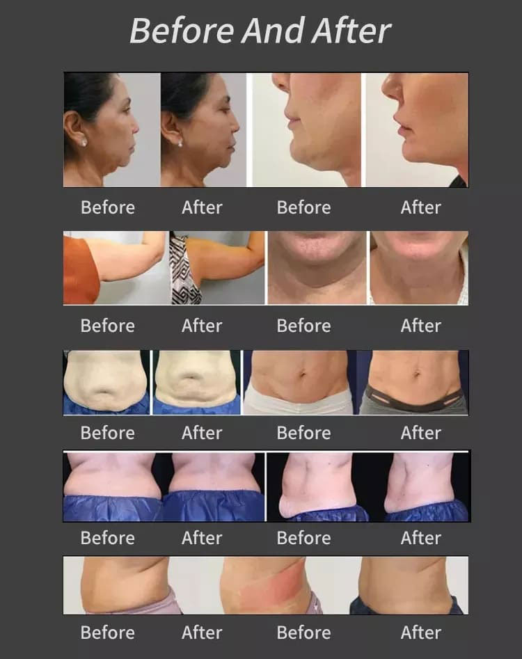 trusculpt id machines before and after