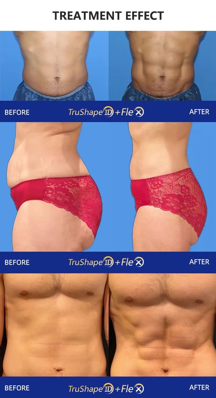 trusculpt machine before after