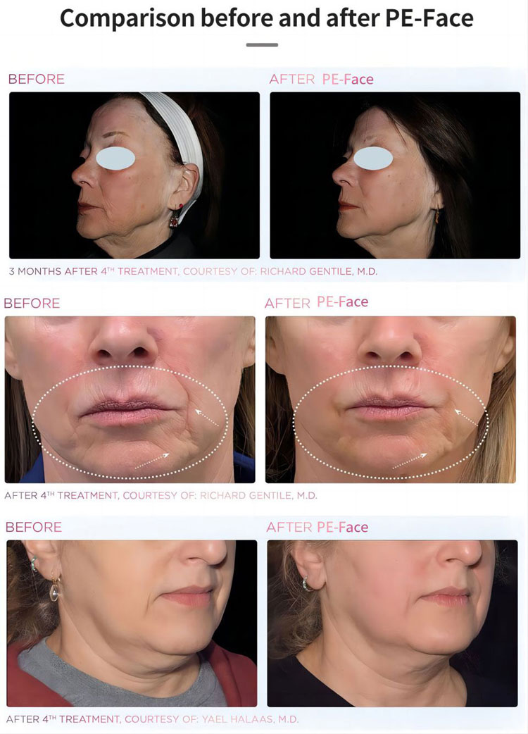 PFFACE Before and After