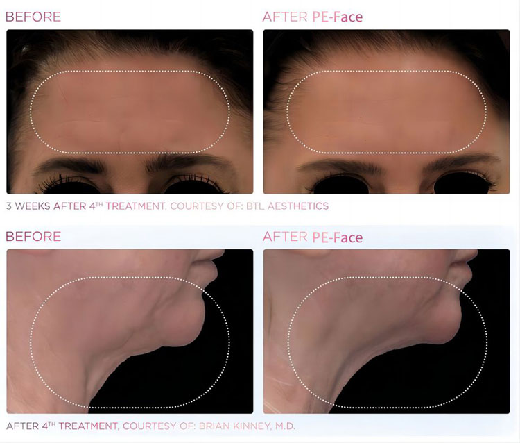 PFFACE Before and After