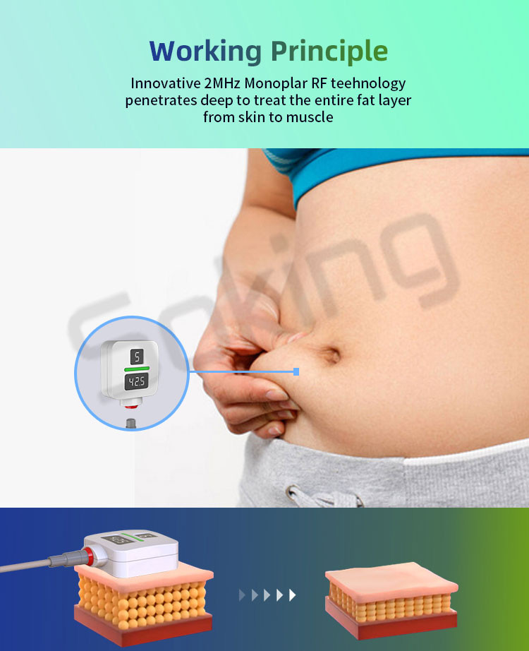 trusculpt fat reduction 