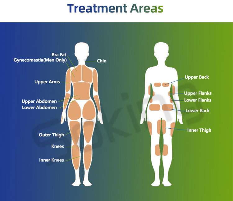 trusculpt fat reduction