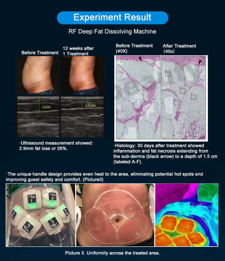 trusculpt flex machine