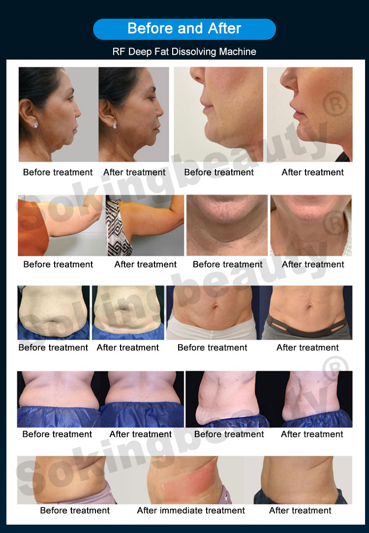 trusculpt machine befpre after