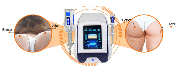 Endospheres therapy Device For Cellulite Treatment