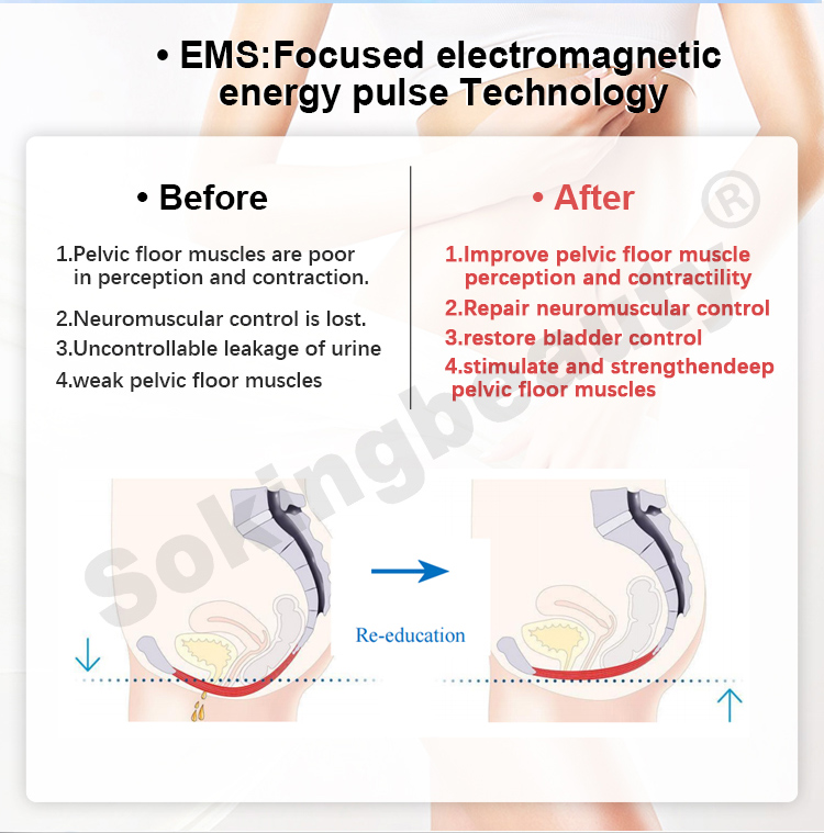 repair pelvic floor muscles chair05