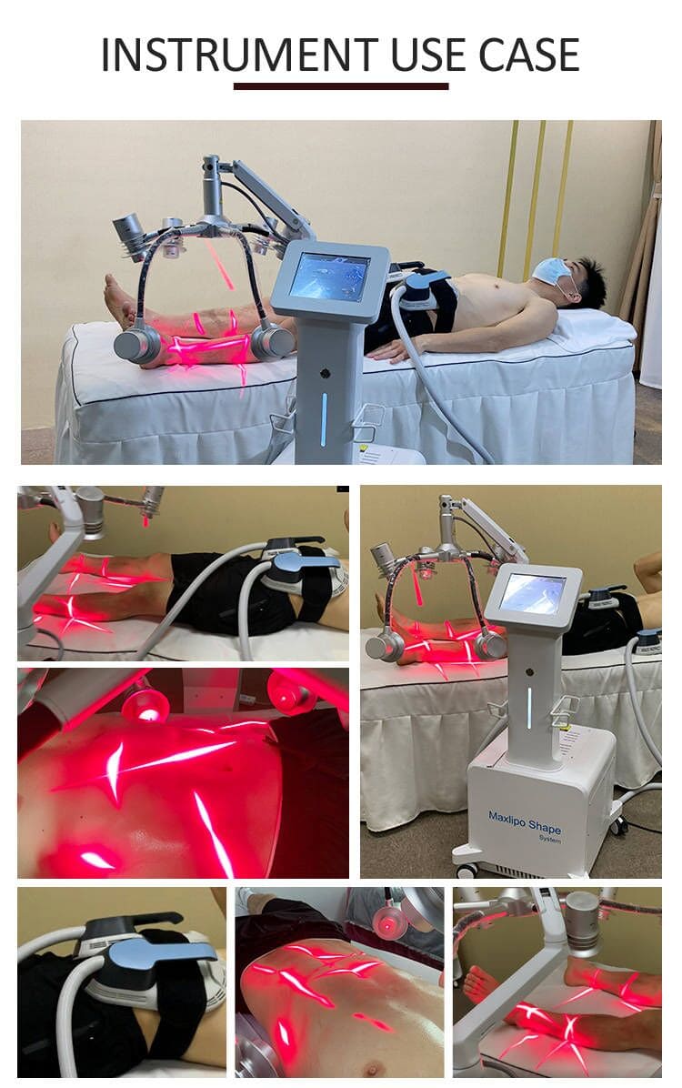 i lipo laser