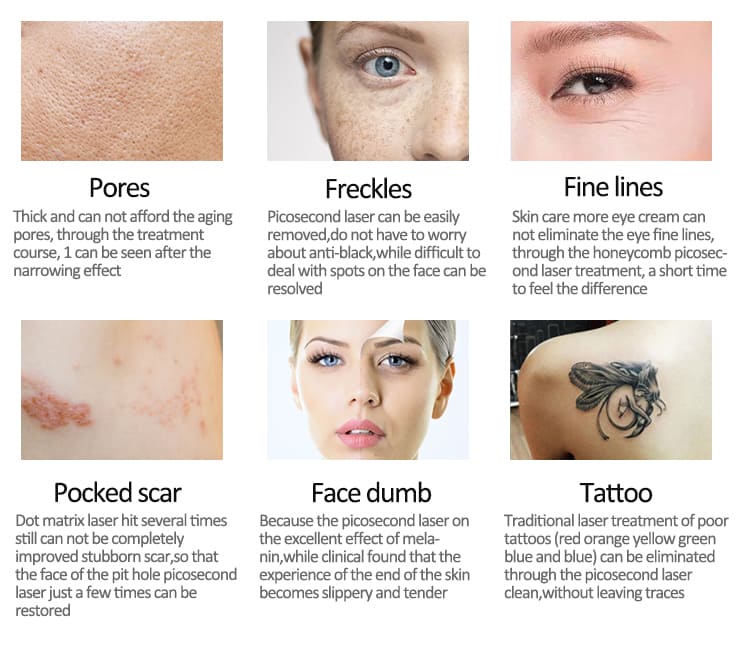 picosure tattoo removal machine for sale