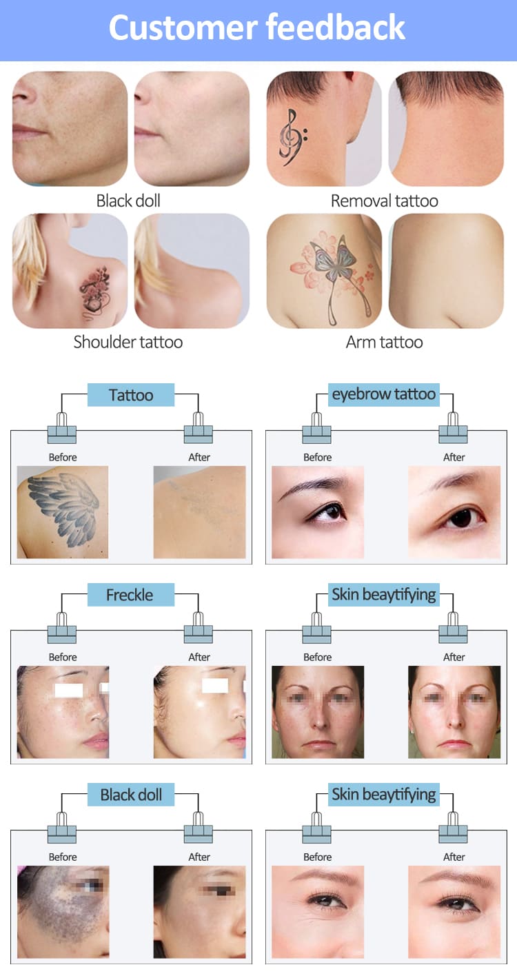 picosure tattoo removal machine price