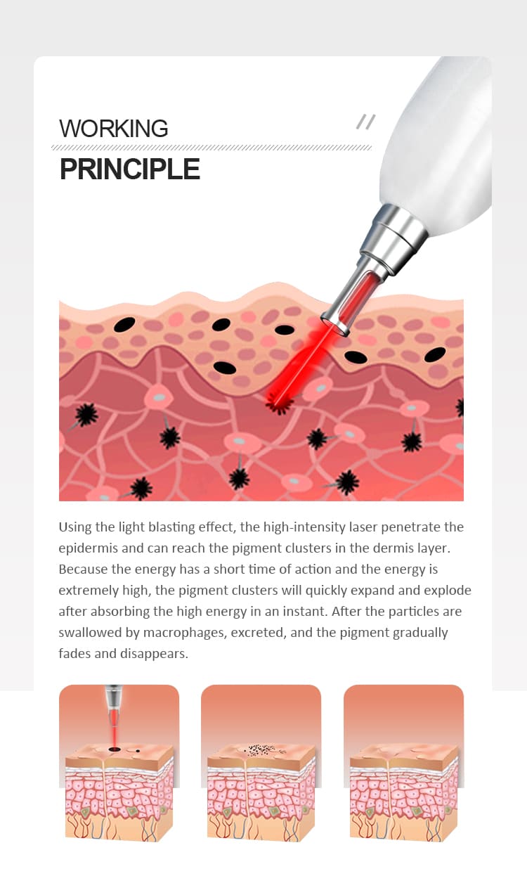 picosure tattoo removal machine