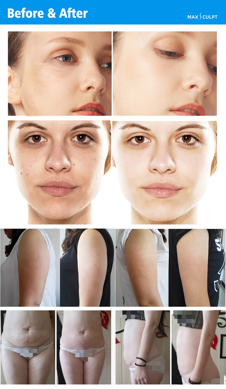 velashape machine21