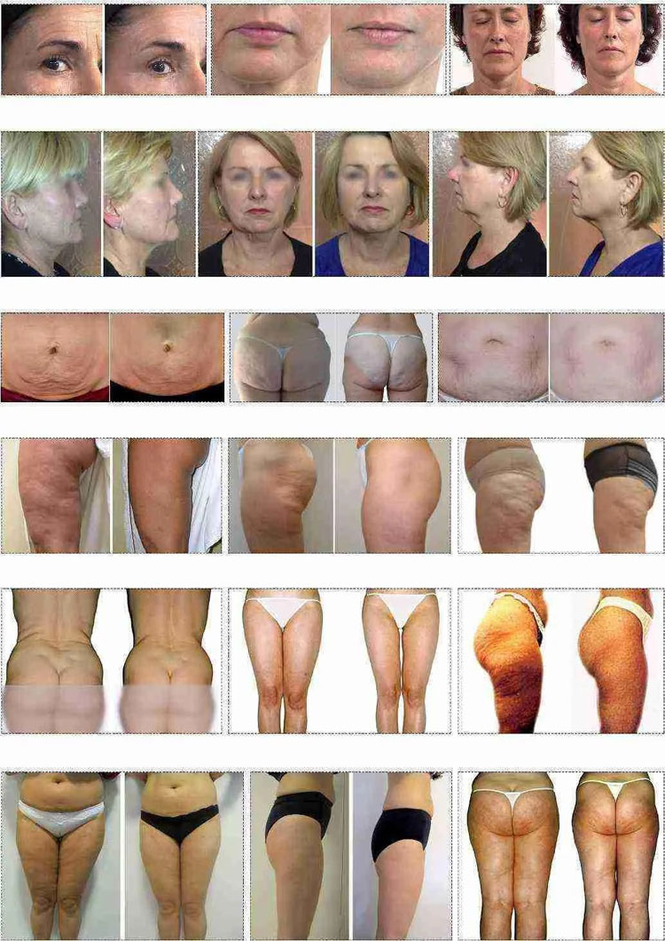velashape machine price before and after
