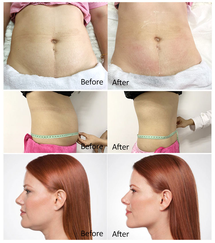 cryolipolysis before and after
