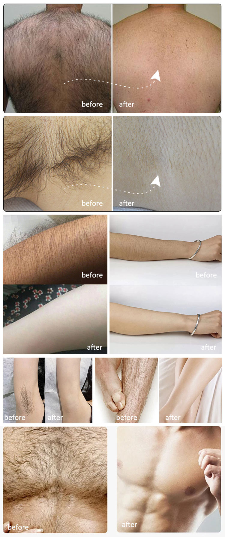 808nm hair removal machine before and after