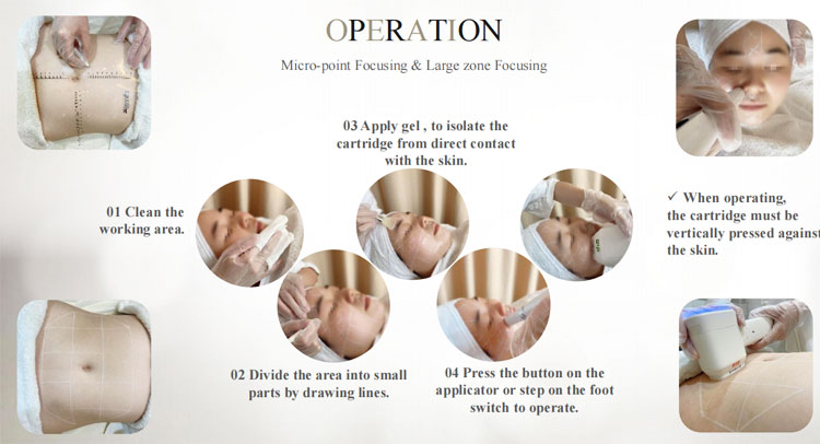 how to operate the 8d hifu machine