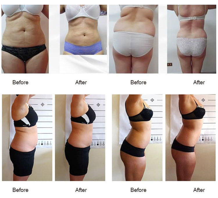 lipo laser slimming machine before after