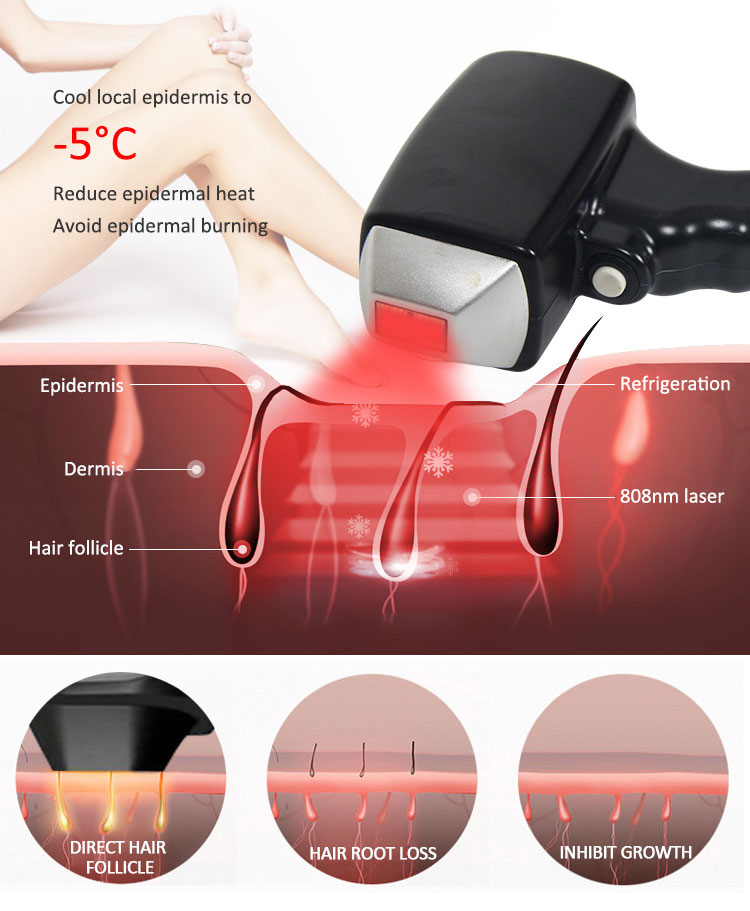 permanent hair removal for men