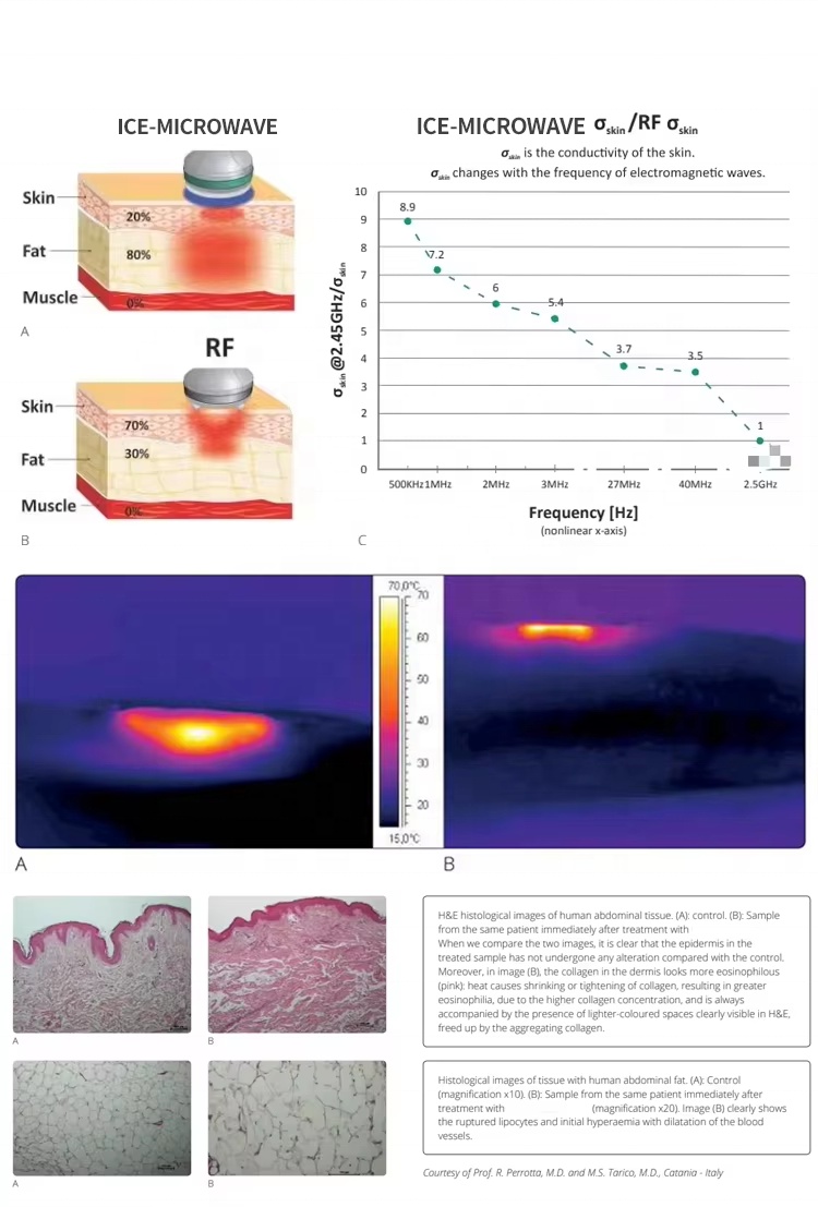 Cool Fat Removal machine06