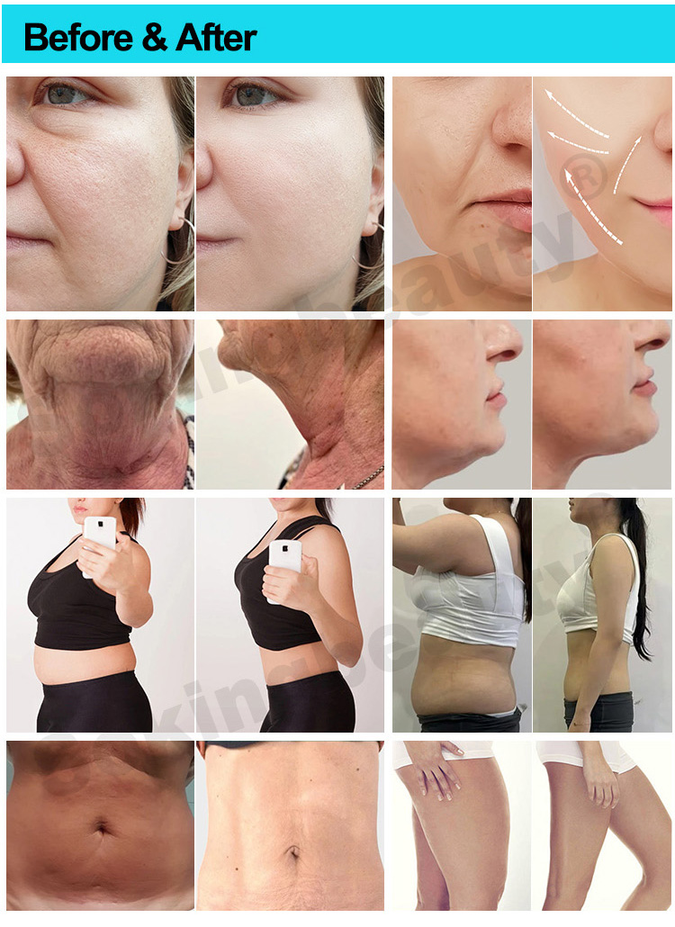 Cryo Fat Reduction Machine19