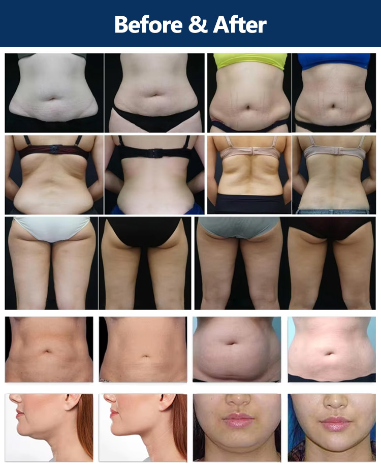 Cryo EMS slimming beauty machine18