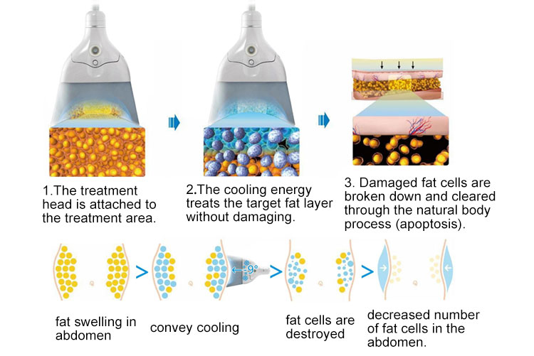 cool sculpting machine