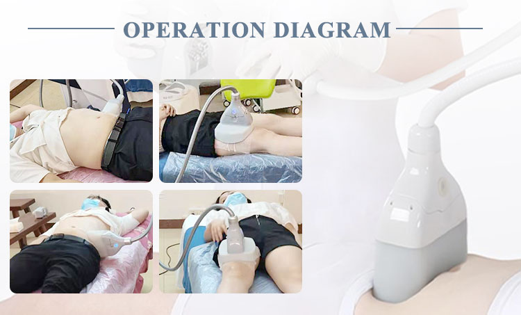 cryolipolysis