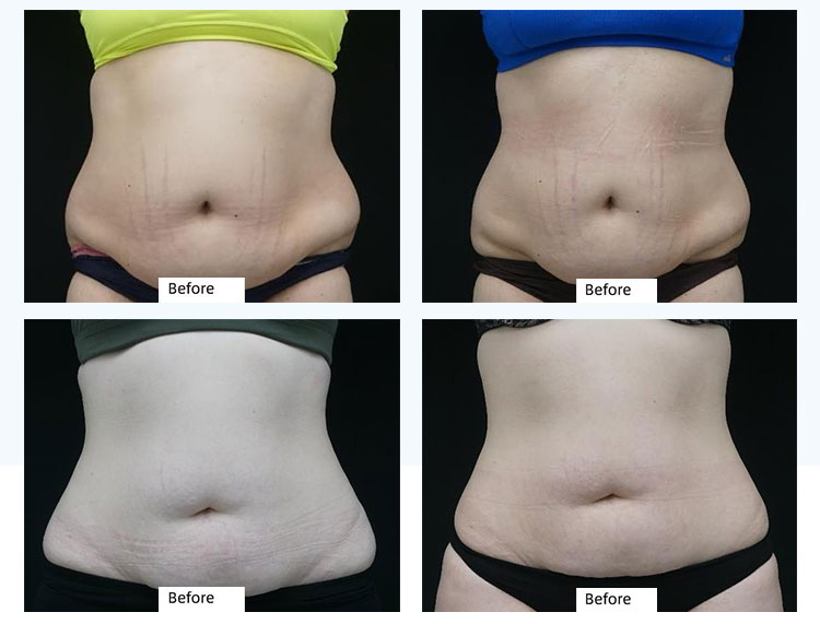 fat freezing machine before and after