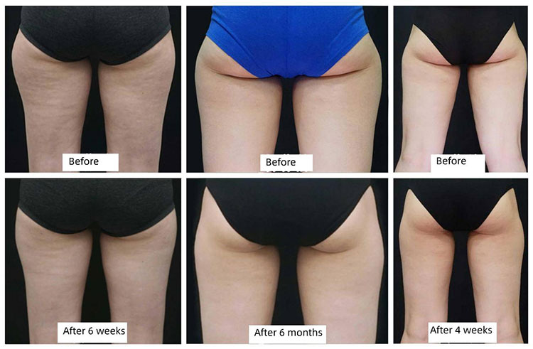 fat freezing machine before and after