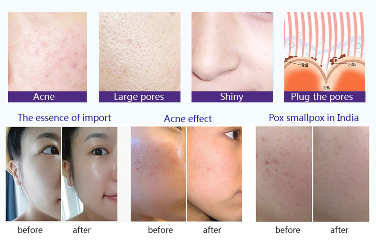 home microneedling devices