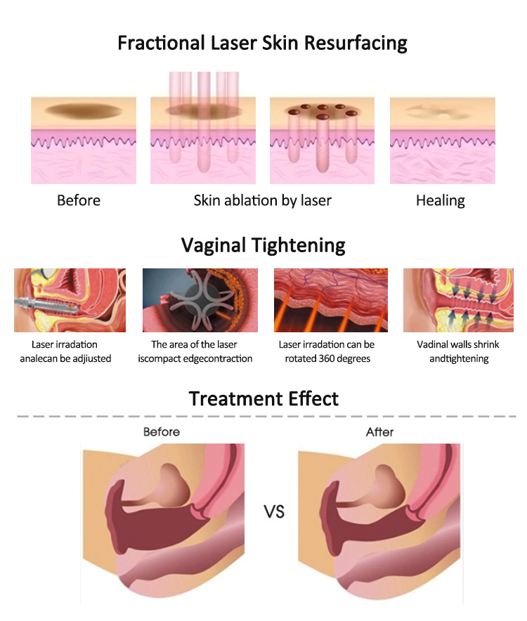 Fractional CO2 Anti Aging Device04