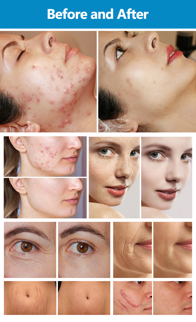 Fractional CO2 Anti Aging Device23