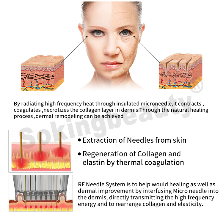 rf microneedling best device