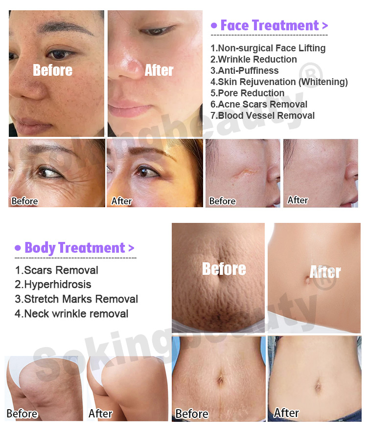 rf microneedling best device