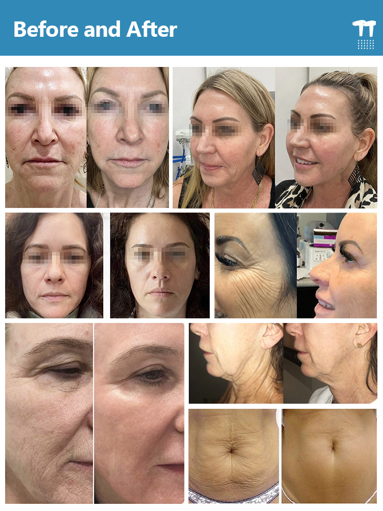 rf microneedling machine fractional20