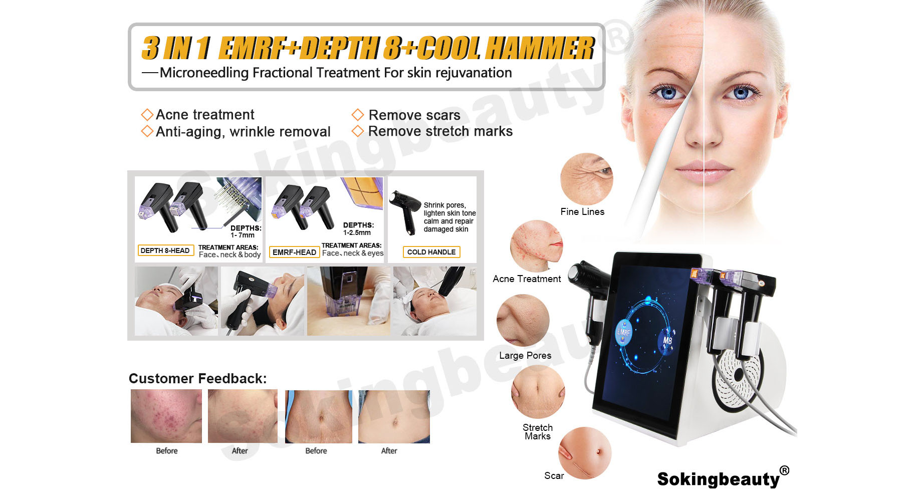 fractional-rf-microneedling-20260423