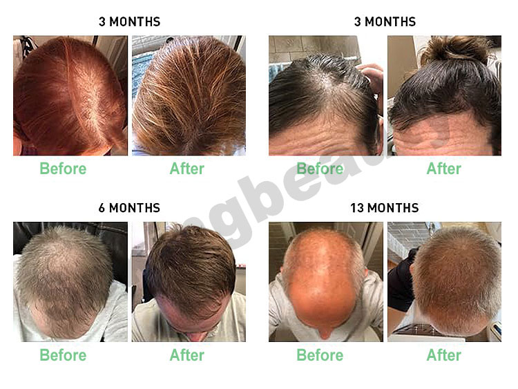 hair growth device before and after
